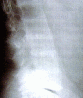 Lumbar Intervertebral Disc Calcification In Alkaptonuria