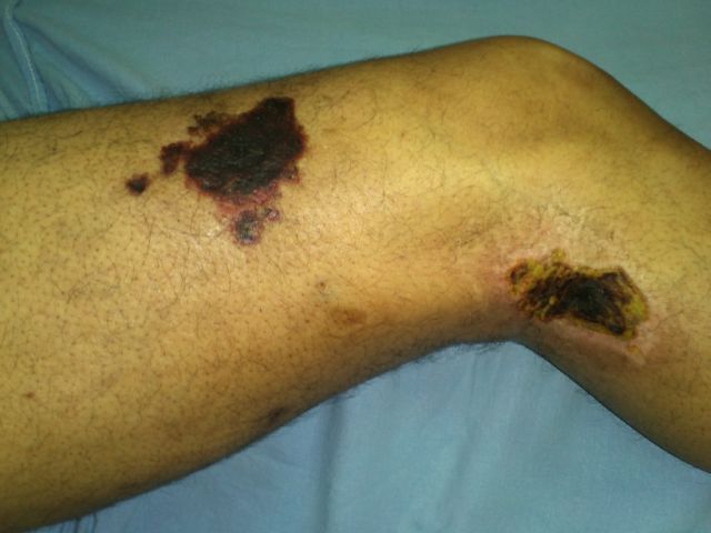 Patchy gangrene due to vasculitis
