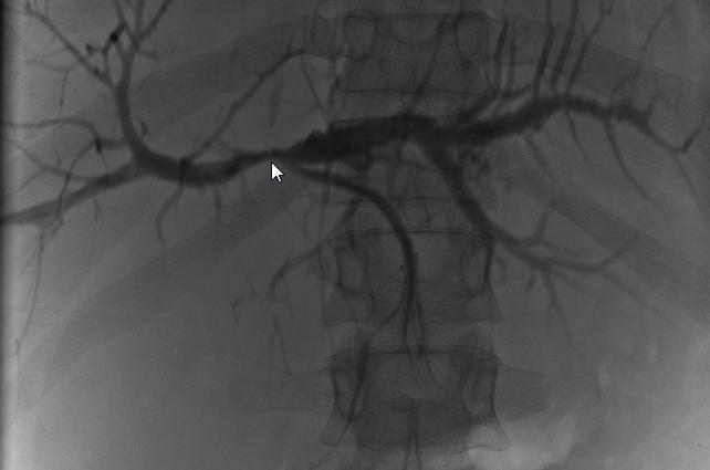 Trans-hepatic cholangiography