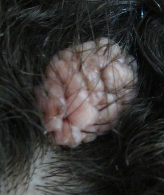 Syringocystadenoma Papilliferum of the scalp