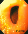 Gastric Pylorus