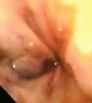 Oesophageal Varix Close-up View